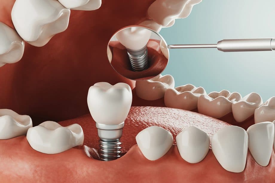 closeup of model showing dental implant
