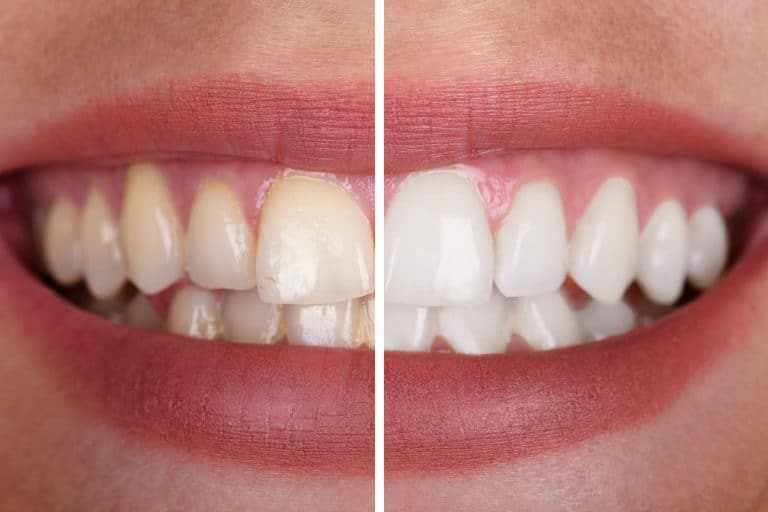 How Much Does Teeth Whitening Cost In Fairfield County, CT?