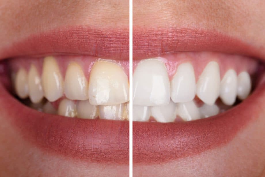 before and after photo of teeth whitening