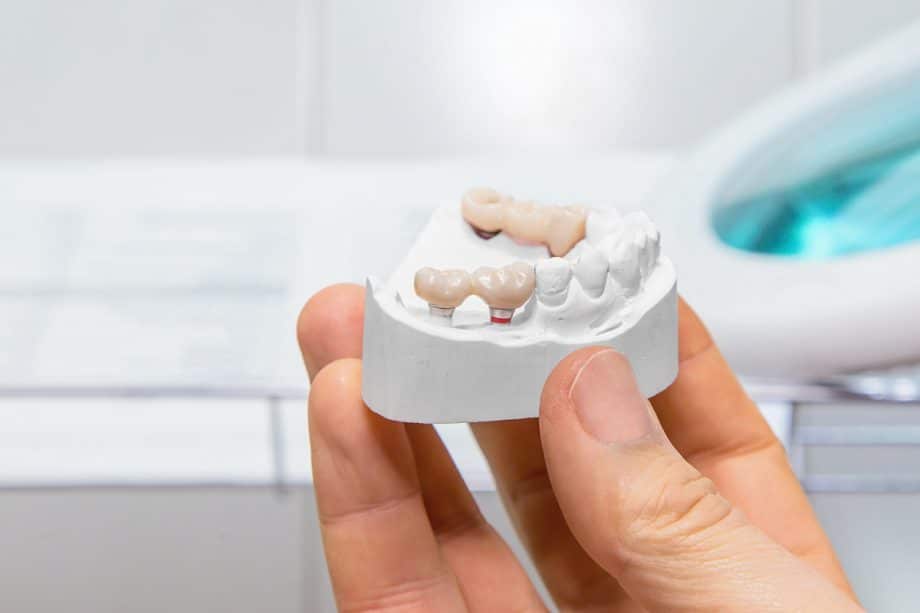 How Long Does It Take For Dental Bridge To Settle?