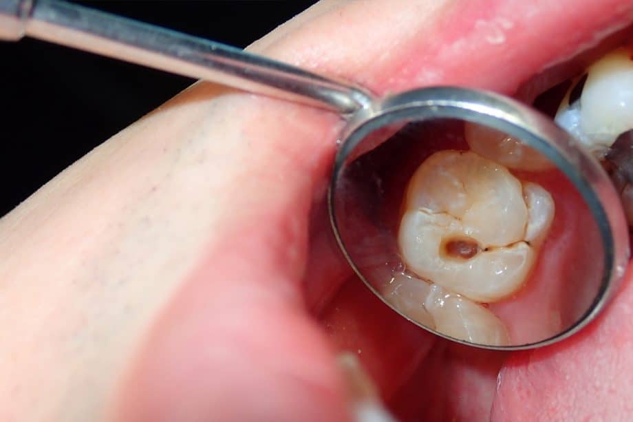 Why Baby Teeth Fillings Are Important | Howard Levitt DDS